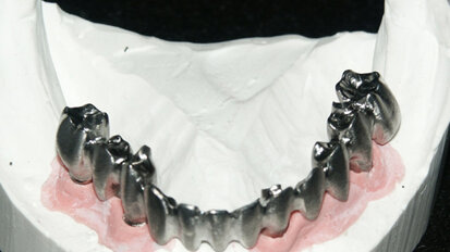 Semplicità realizzativa di una struttura complessa “Toronto” attraverso l’utilizzo di SUM3D Dental