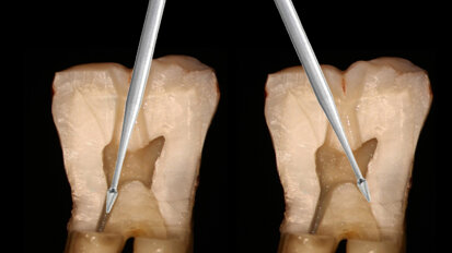 Conservative restorative-driven endo: Preserving tooth structure while achieving treatment goals