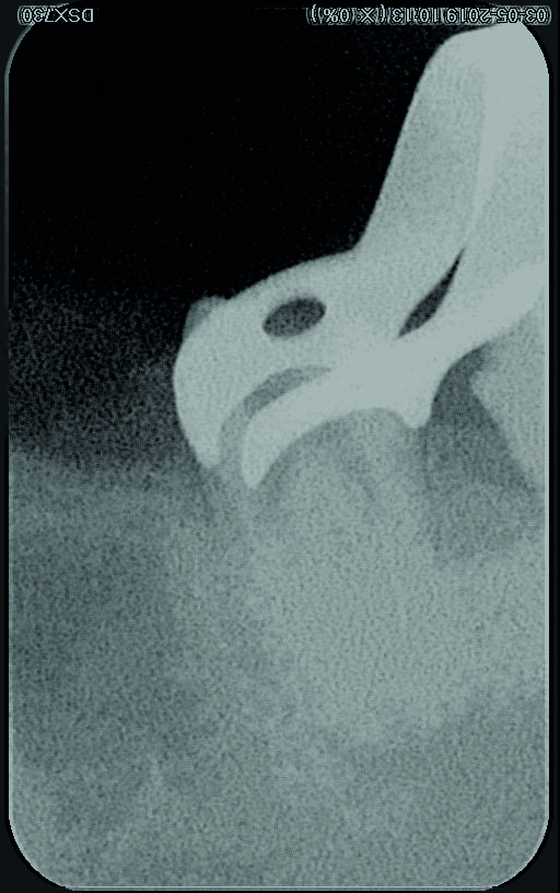 Fig. 13 : Radiographie après retrait du fragment. 