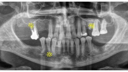 Détection des pathologies périapicales sur les radiographies dentaires