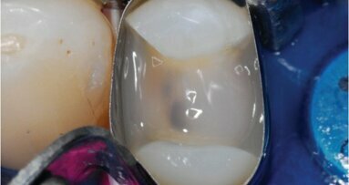 Clinical application of a new flowable base material for direct and indirect restorations