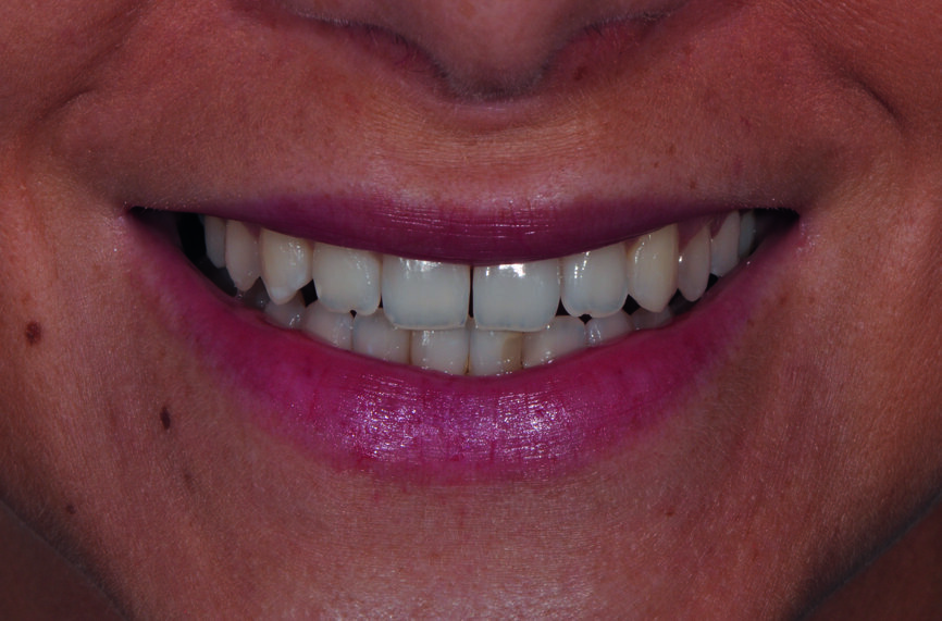 Fig. 4 : a) Gros plan du sourire avant le traitement. 