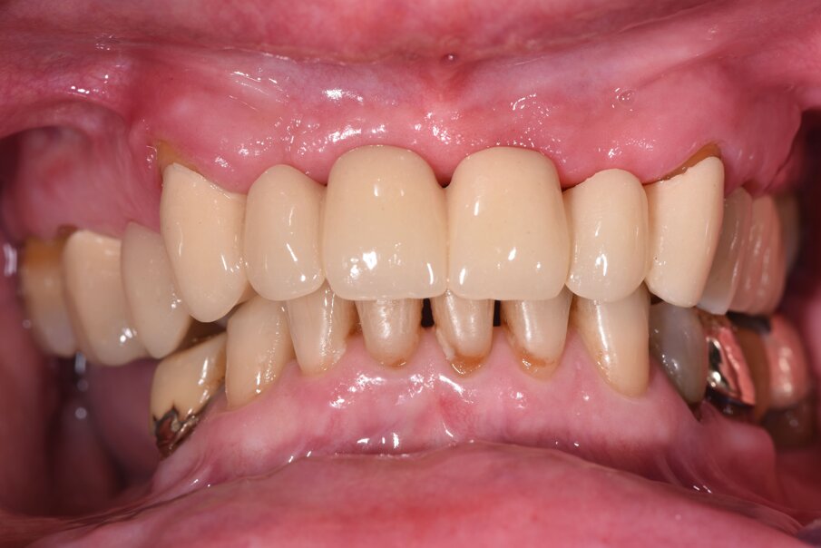 Fig. 16_Il primo provvisorio eseguito in prematura e posizionato sull’intera arcata dentaria escludendo i secondi molari.