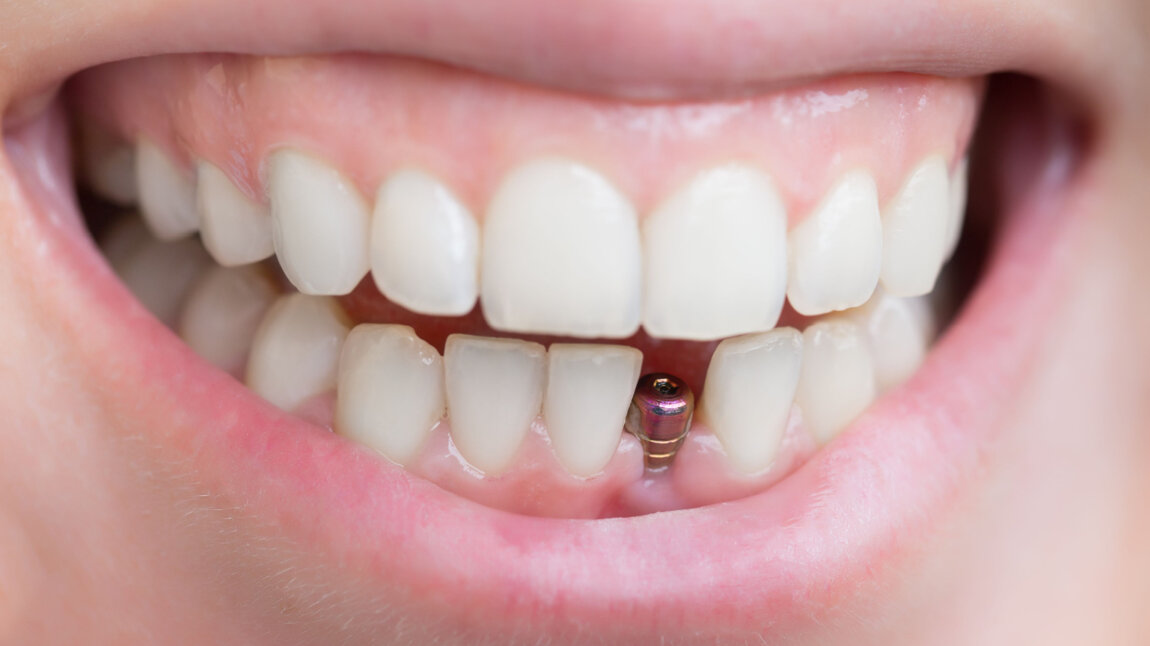 New EFP Guidelines Help Peri-implant Disease Treatment