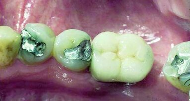 Restauration d’une molaire unitaire – Implant de large diamètre versus deux implants conventionnels