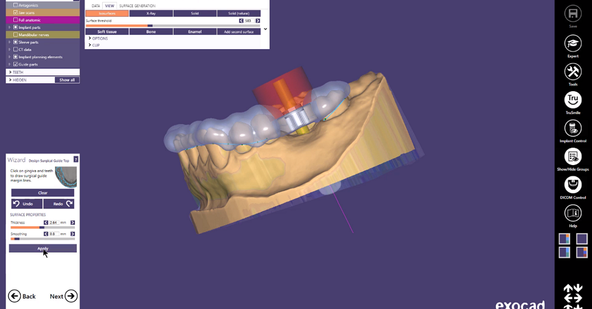 exocad Quick Guide Get most out of guided surgery
