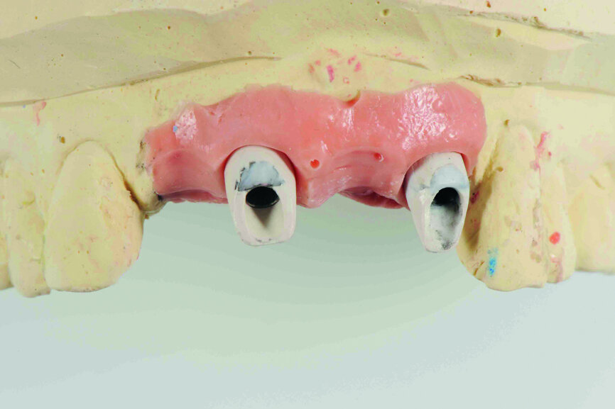 Fig. 13: Reshaping of the artificial gingival contour on the model in order to obtain a good gingival aesthetic effect (performed by dental technician Samuel Chou).