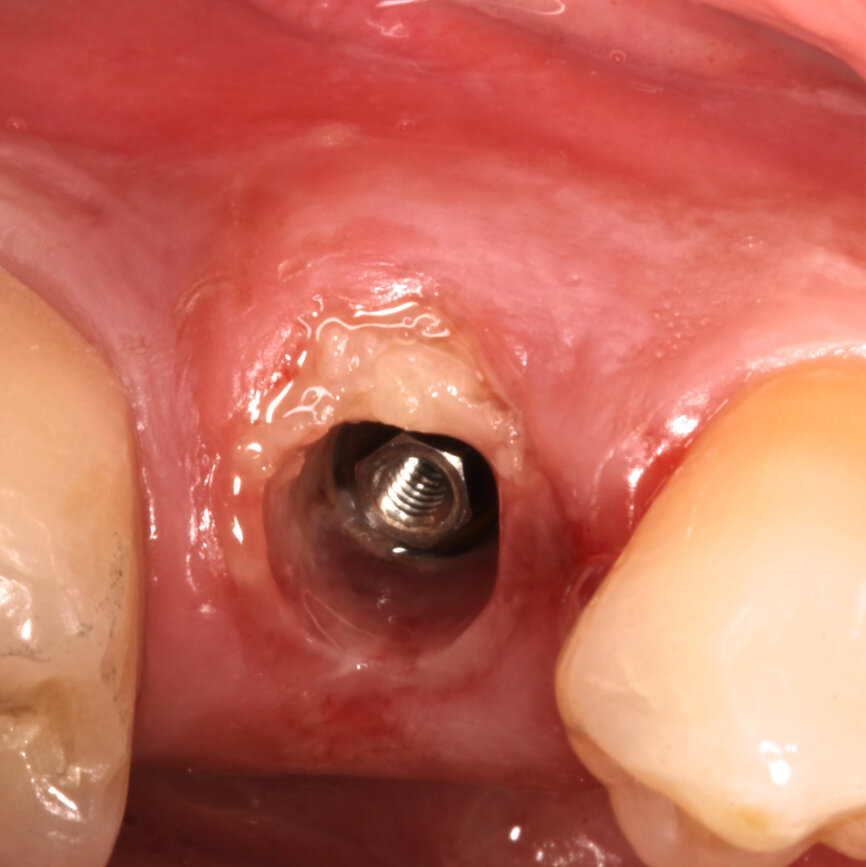 Fig. 5: The gap distance between the implant and the SS was filled solely with Endoret.