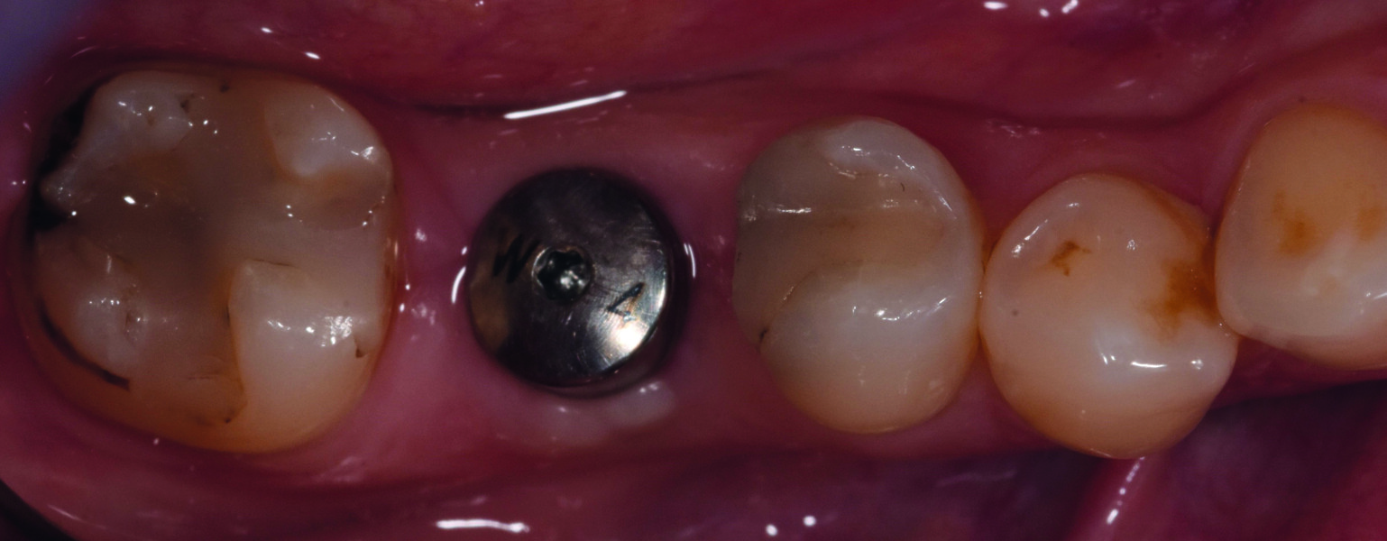 Fig. 14 : Vue occlusale du pilier de cicatrisation vissé dans le col implantaire.