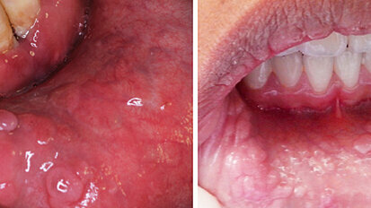 Fig. 4. Hiperplasia epitelial multifocal. Patología benigna de la mucosa oral, caracterizada por lesiones múltiples, bien definidas, del mismo color de la mucosa oral.