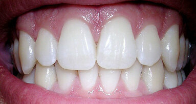 Cruciaal kenmerk dentale stamcel ontdekt