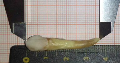 Novi svetovni rekord: nemški zobozdravnik je izvlekel najdaljši človeški zob na svetu