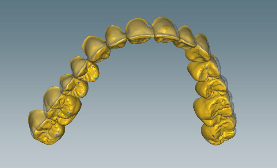 Fig. 4: The occlusal design was created, and the contacts placed on unveneered zirconia. These should not be positioned directly on the veneer interface.