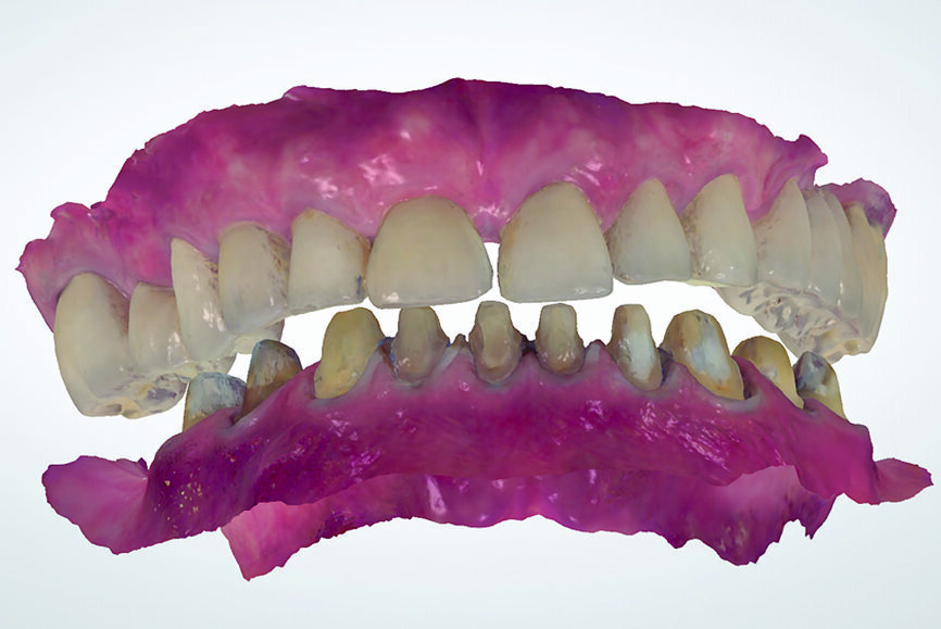 Fig. 25: Digital centric relation recording at the desired vertical
dimension of occlusion of all existing mandibular teeth, in preparation for a fixed complete denture.