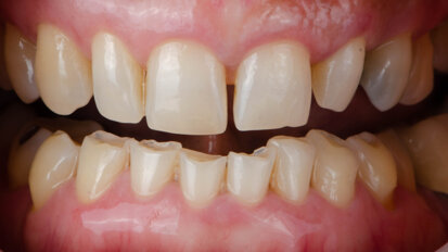 Kako bruksizam utiče na zubne nadoknade?
