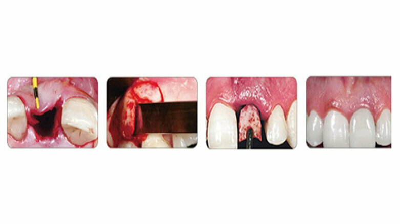 Νέα Τεχνική IDR -Άμεσης Οδοντοφατνιακής Αποκατάστασης σύμφωνα με τον Dr.J.C.M. Rosa