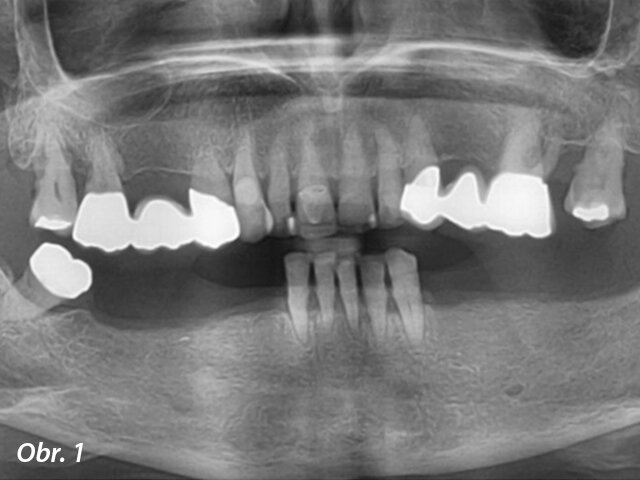 Panoramatický RTG snímek počátečního stavu zubů.
