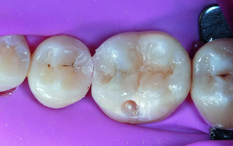 Fig. 9. Final occlusal morphology was achieved with build-up of each cusp using Beautifil Injectable X shade A2.