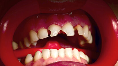 Nieuwe tandzorgverzekeraar voor ongevallen