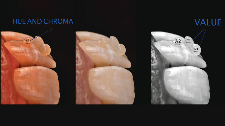Fig 6. Direct shade selection with Beautifil II LS enamel and dentin shades