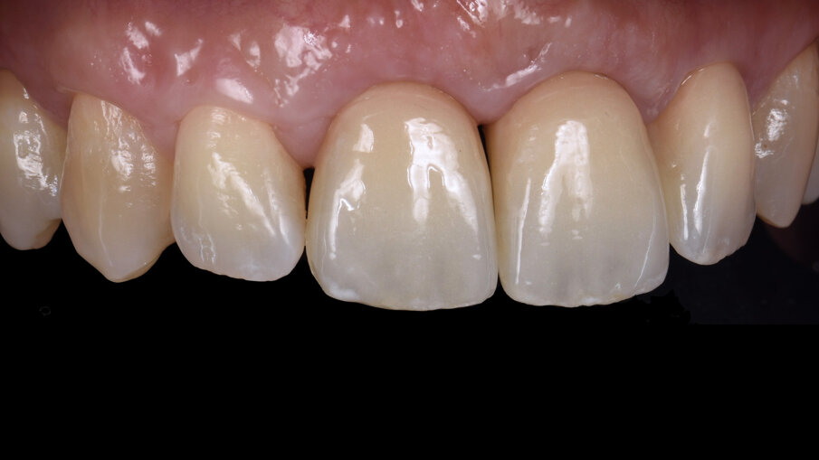 Figg. 15, 16_Risultato finale, si può notare l’ottima integrazione delle corone con i denti adiacenti.