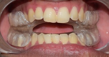 Management of Temperomandibular Joint disorders  and Obstructive sleep apnoea  in the dental office using TENS and k7 therapy