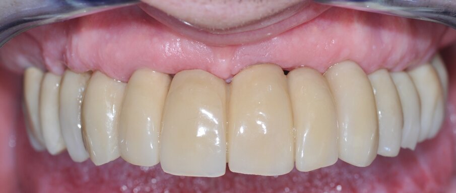 Fig. 6_Foto intra-orale a tre anni dall’intervento in cui si apprezza la salute e il buon mantenimento delle mucose.