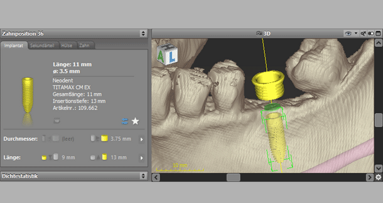 Dental-Wings-Software coDiagnostiX jetzt mit Neodent-Implantaten