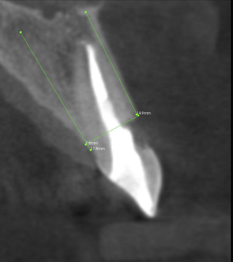 Fig. 2: CBCT scan: the root of the tooth was visibly fractured, and there was clear external resorption of the root from the vestibular side.