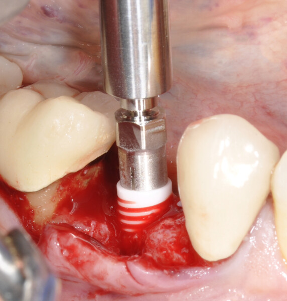 Fig. 3: Pose de l’implant Neodent Zi 4.3. 