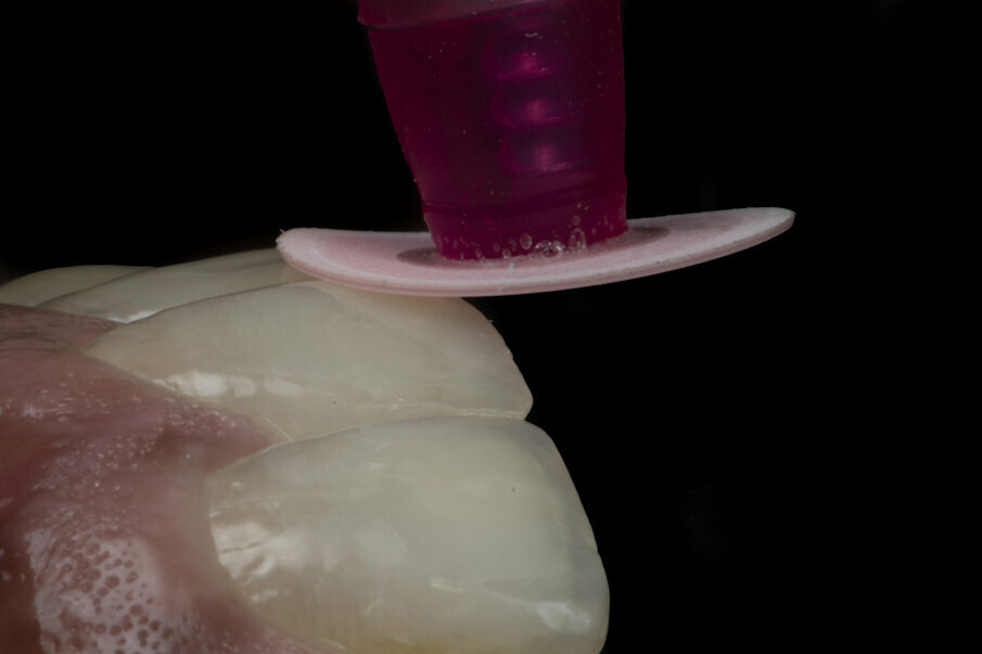 Fig. 13: Polishing with Super Snap X-Treme green disk followed by  pink disc clearly showing the reflection on the tooth