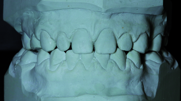 Interdisciplinary treatment of a patient with 11 missing permanent teeth: A biomimetic approach