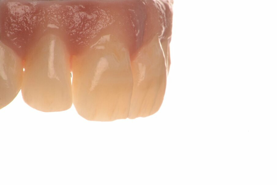 Fig. 27a: Polished gingiva and teeth, view from two different angles.