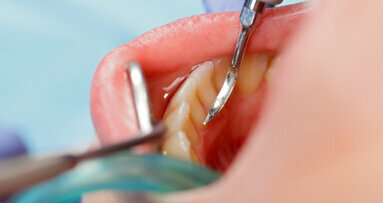 El curetaje dental reduce el riesgo de infección tras el reemplazo de rodilla