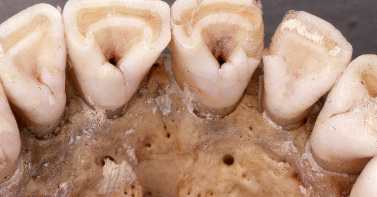 mutation from last ice age linked to shovelshaped incisors
