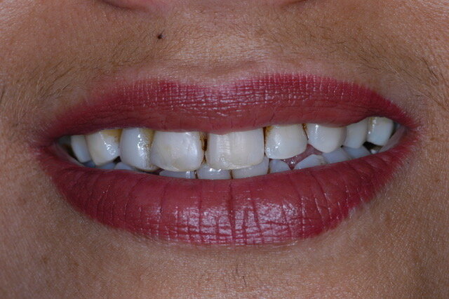 Fig 1A: Frontal smile view: Before