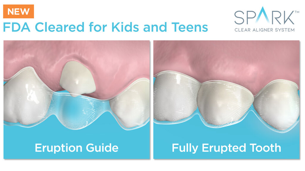Ormco announces FDA approval to treat mixed dentition with Spark clear aligners