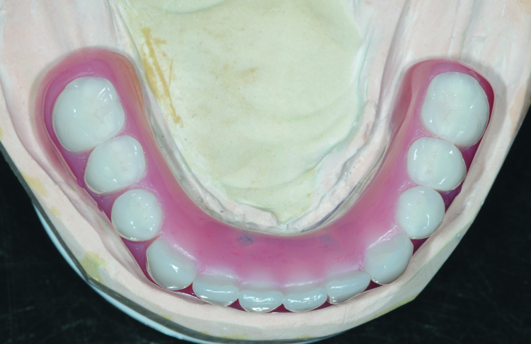 Fig. 10: Completed laboratory restoration; note the termination the arch at the first molar to avoid excessive cantilever length. The chrome frame is opaqued on the functional side to prevent gray show-through.