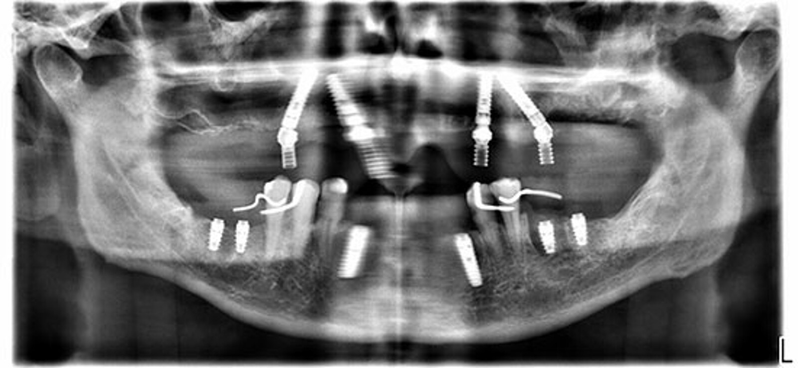 Fig. 22. OrtopantomografÃ­a postoperatoria inmediata donde se observan los implantes angulados distales. 