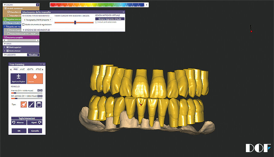 Fig. 11: Digital tooth arrangement with static and dynamic occlusion.