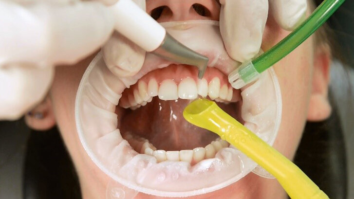 5 mýtů o pískování zubů, které nejsou pravdivé a přimějí Vás přehodnotit protokol dentální hygieny