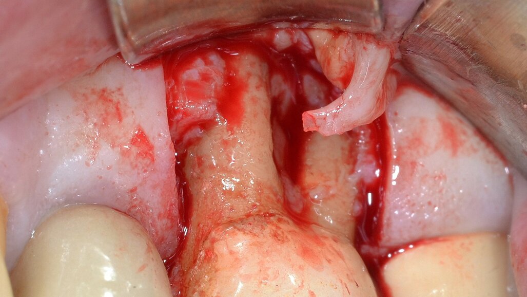 Ruolo della chirurgia osseo-resettiva nella terapia delle lesioni endo-parodontali: descrizione di un caso clinico