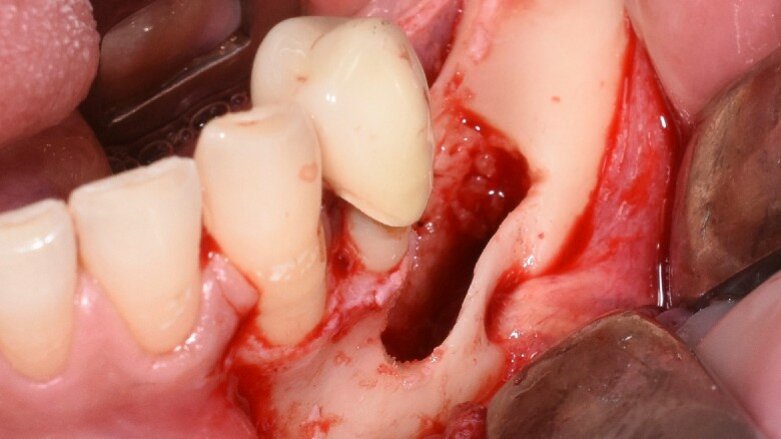 Chirurgia piezoelettrica dei denti inclusi: case report