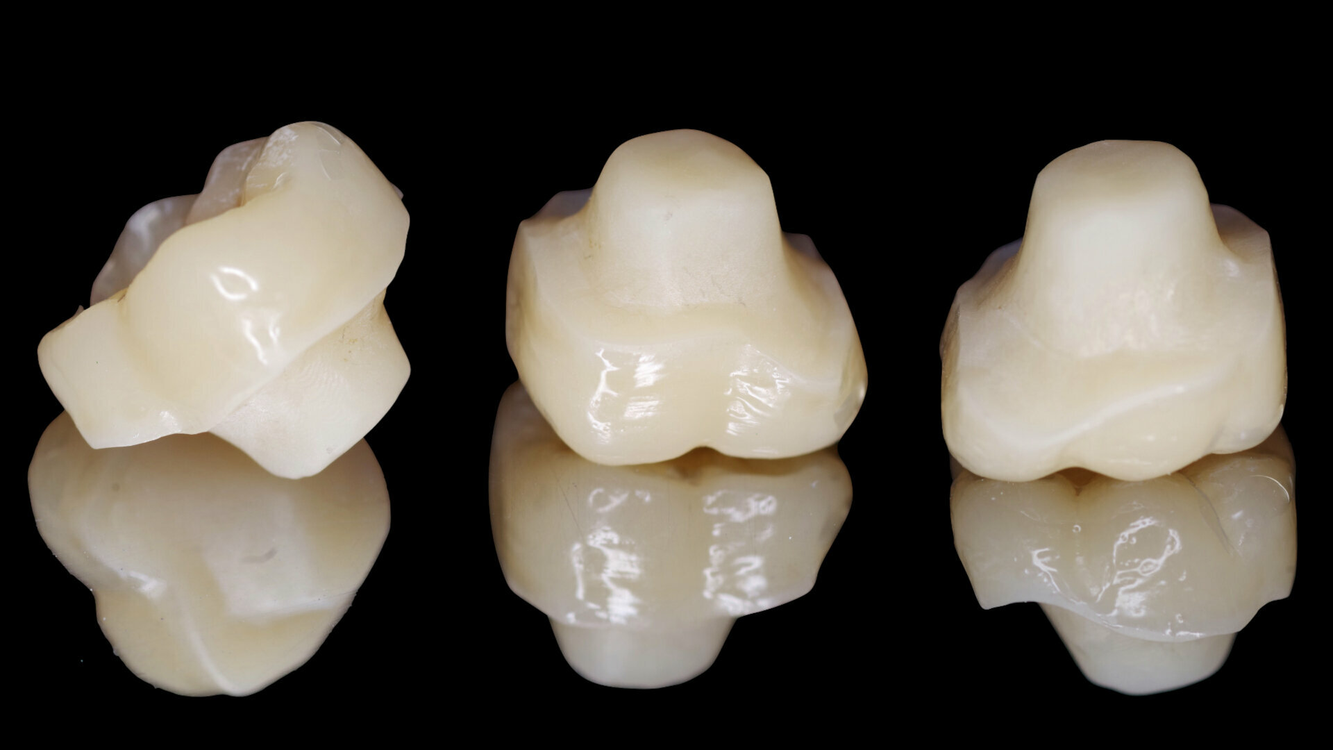 Chairside fabrication of a nano-ceramic hybrid composite endocrown for a severely damaged molar after endodontic treatment
