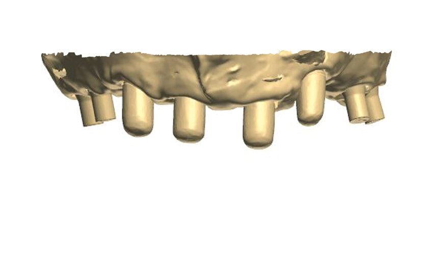 Fig. 1: A virtual image of a scanned model with abutments and telescopic crowns.