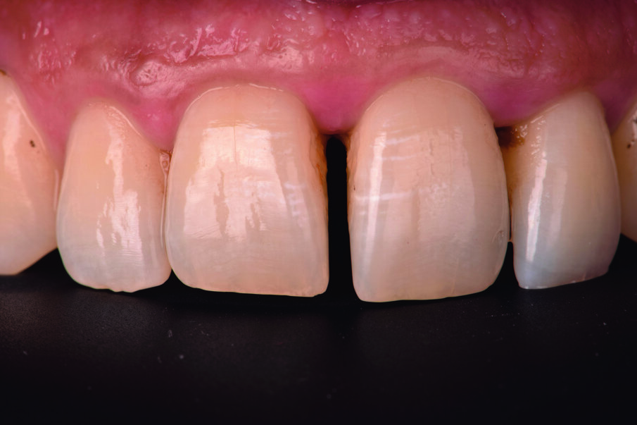 Fig 2. Pre-operative diastema between upper central incisors