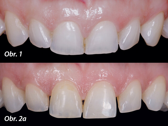 Obr. 2a: Přední zuby po ortodontické léčbě. Obr. 2b: Extraorální fotografie po ortodontické léčbě.