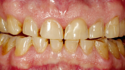 Full-mouth restoration with Zolid FX— a successful concept for sophisticated prostheses