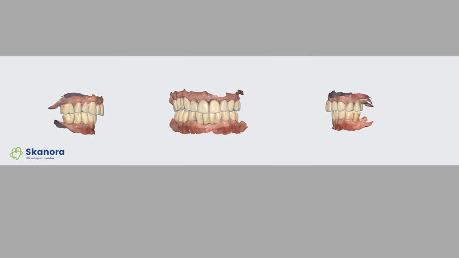 Slika 3a Intraoralni sken privremenh mosova u ustima, zub bez krune na poziciji 35 . (dr Dejan Stajčić)