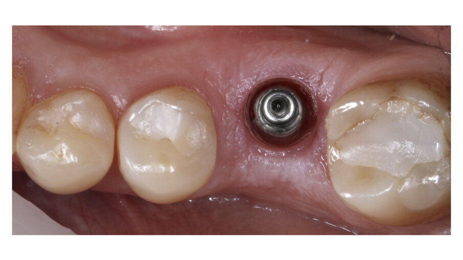 Fig. 1: Implant placed lingually due to the normal resorption of the buccal plate.